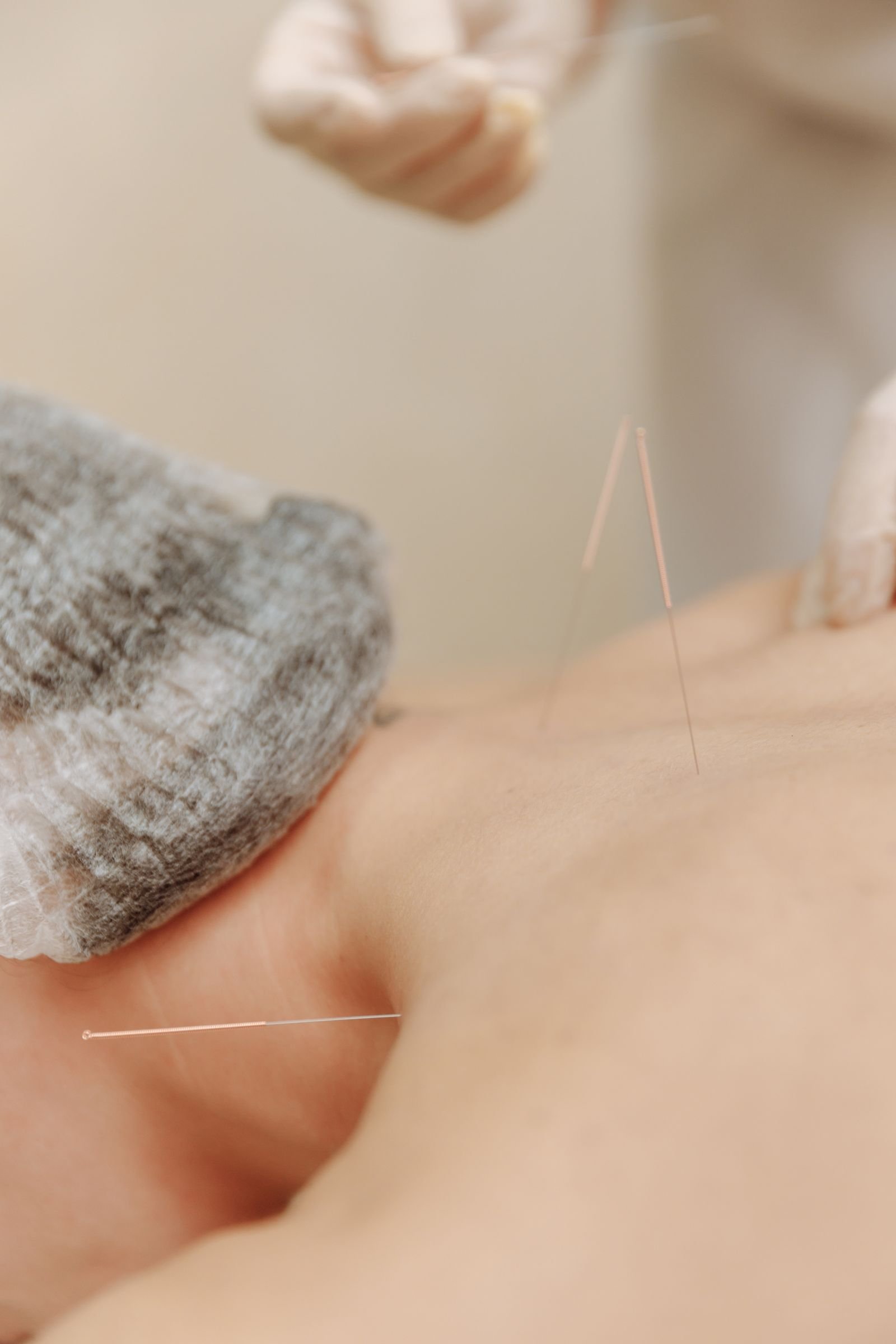 Dry needling -neuloja asiakkaan selässä